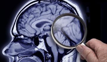Imagen de Alzheimer: un hallazgo podría permitir la detección temprana