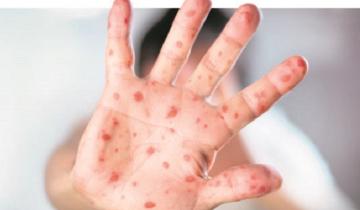 Imagen de Alerta epidemiológica: confirman otro caso de sarampión en la Provincia y reiteran los cuidados