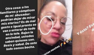 Imagen de Miss Bolivia denunció a su ex marido por violencia y mostró fotos de su cuerpo golpeado