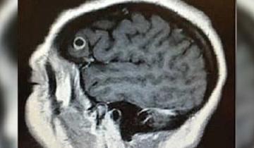 Imagen de Olvidaba palabras, se le caían las cosas, fue al doctor y hallaron un gusano en su cerebro